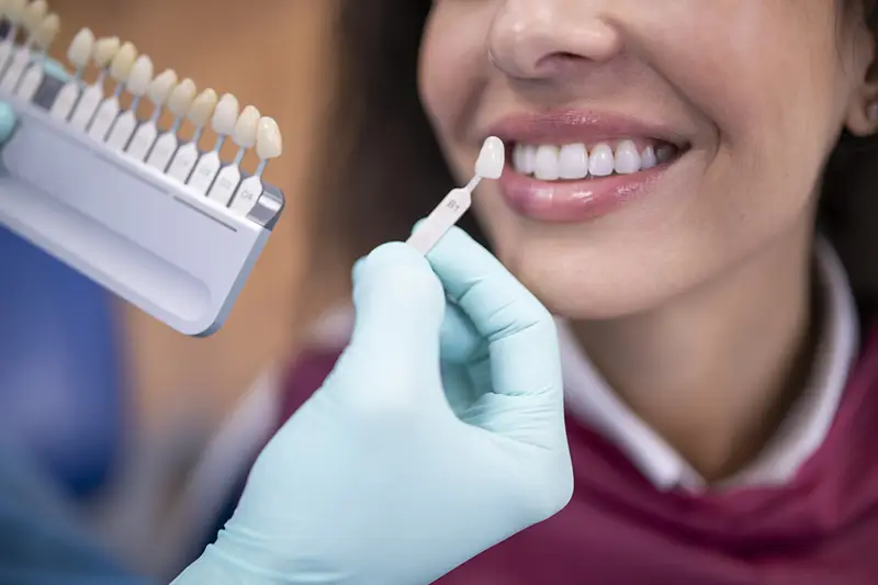 Benefits of veneers