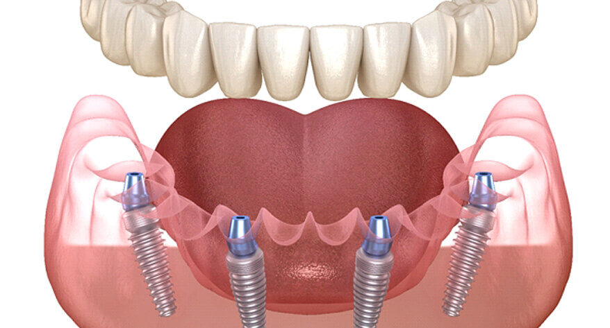Pr&oacute;tesis dentales para dientes faltantes