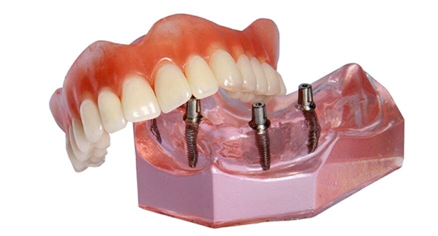 Ilustraci&oacute;n de pr&oacute;tesis dentales sobre implantes