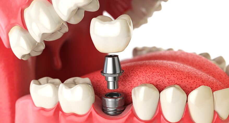 &iquest;Qu&eacute; es un implante dental?