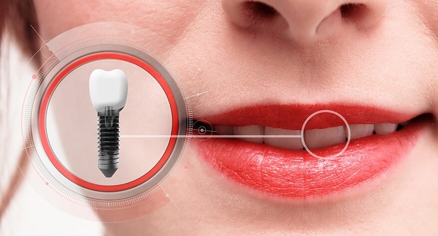 Indicaciones de los implantes dentales