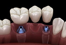Faltan varios dientes