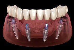 Si te faltan todos los dientes