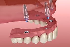 Dientes en 4 dientes/Dientes en un d&iacute;a