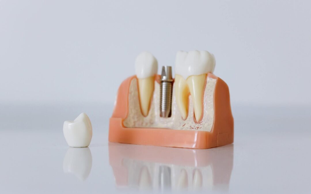 Best Dental Crown Materials