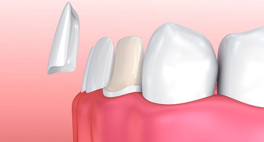 How veneers work
