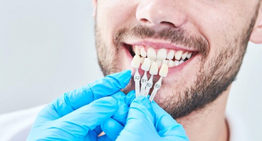 Understanding veneer costs