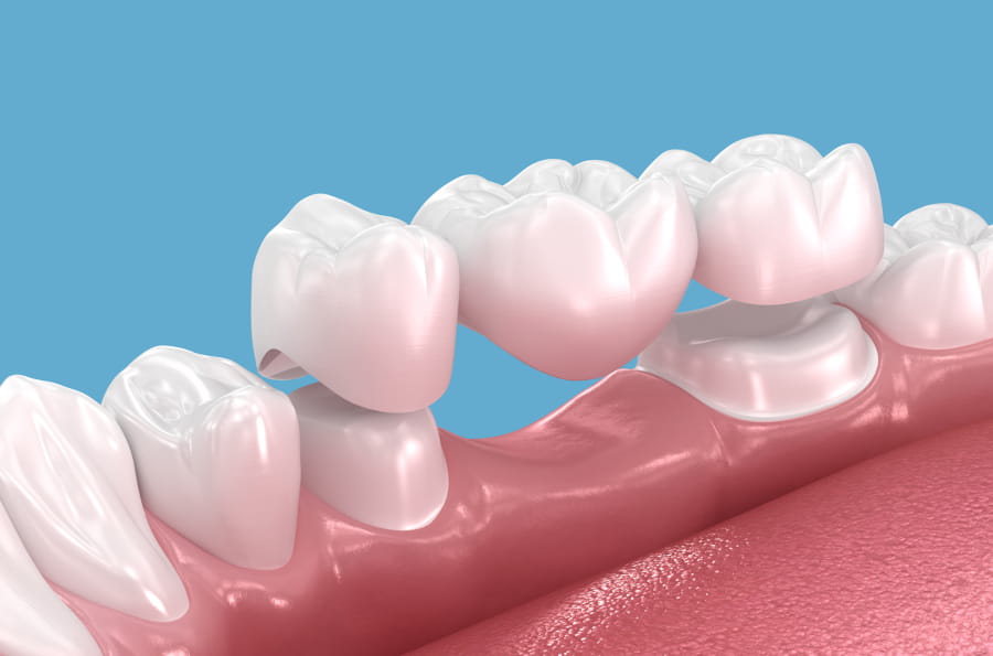 What Is a Dental Bridge - Mesa Dental Innovations